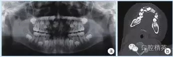 頜骨良性成牙骨質(zhì)細(xì)胞瘤 頜骨良性成牙骨質(zhì)細(xì)胞瘤