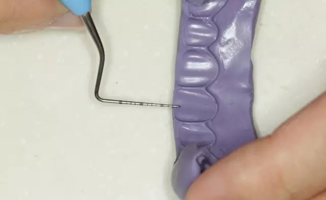 硅橡膠導(dǎo)板——牙體預(yù)備步驟詳解 硅橡膠導(dǎo)板——牙體預(yù)備步驟詳解