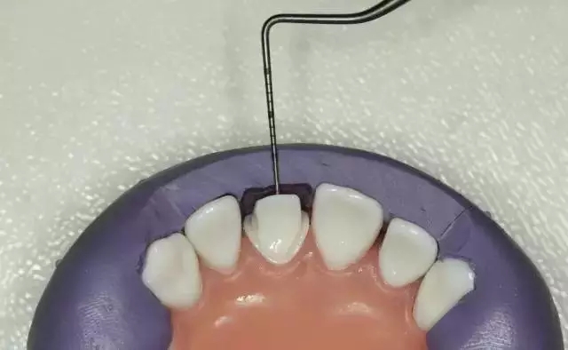 硅橡膠導(dǎo)板——牙體預(yù)備步驟詳解 硅橡膠導(dǎo)板——牙體預(yù)備步驟詳解