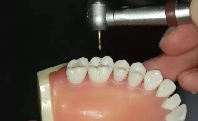 硅橡膠導(dǎo)板——牙體預(yù)備步驟詳解 硅橡膠導(dǎo)板——牙體預(yù)備步驟詳解