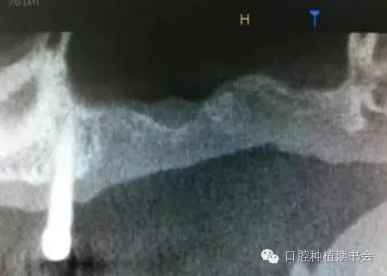 上頜后牙區(qū)種植治療的關(guān)鍵技術(shù)之&mdash;上頜竇提升術(shù)