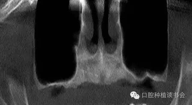 上頜后牙區(qū)種植治療的關(guān)鍵技術(shù)之&mdash;上頜竇提升術(shù)
