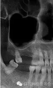 上頜后牙區(qū)種植治療的關(guān)鍵技術(shù)之&mdash;上頜竇提升術(shù)