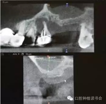 上頜后牙區(qū)種植治療的關(guān)鍵技術(shù)之&mdash;上頜竇提升術(shù)