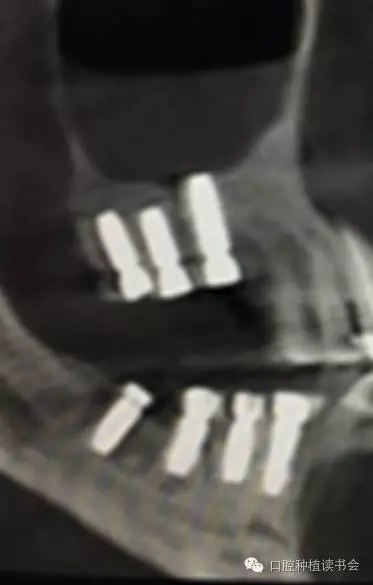 上頜后牙區(qū)種植治療的關(guān)鍵技術(shù)之&mdash;上頜竇提升術(shù)