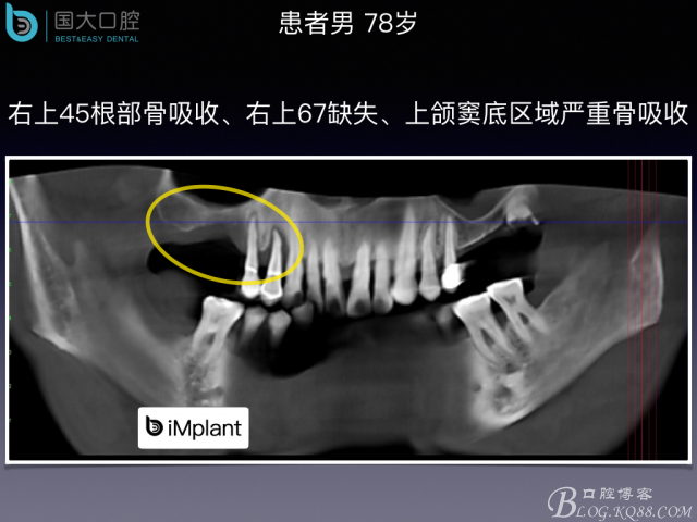 上頜竇底區(qū)域嚴(yán)重骨吸收的臨床種植案例.jpeg 上頜竇底區(qū)域嚴(yán)重骨吸收的臨床種植案例.jpeg