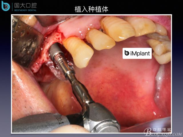 上頜竇底區(qū)域嚴(yán)重骨吸收的臨床種植案例.jpeg 上頜竇底區(qū)域嚴(yán)重骨吸收的臨床種植案例.jpeg