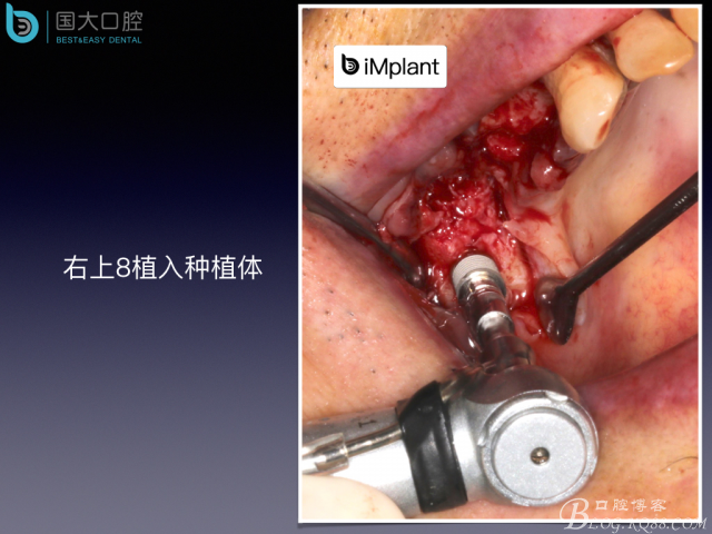 上頜竇底區(qū)域嚴(yán)重骨吸收的臨床種植案例.jpeg 上頜竇底區(qū)域嚴(yán)重骨吸收的臨床種植案例.jpeg