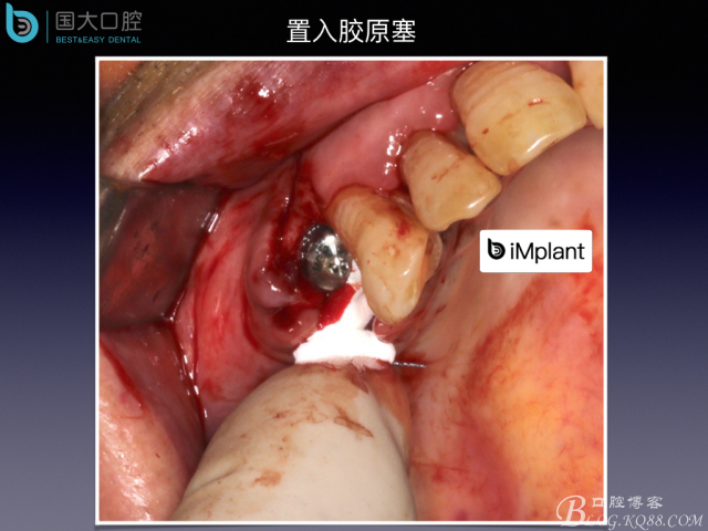 上頜竇底區(qū)域嚴(yán)重骨吸收的臨床種植案例.jpeg 上頜竇底區(qū)域嚴(yán)重骨吸收的臨床種植案例.jpeg