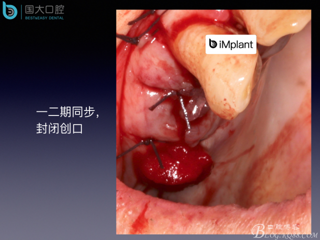 上頜竇底區(qū)域嚴(yán)重骨吸收的臨床種植案例.jpeg 上頜竇底區(qū)域嚴(yán)重骨吸收的臨床種植案例.jpeg