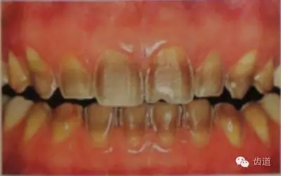 瓷貼面的粘接步驟及技術(shù)要點(diǎn) 瓷貼面的粘接步驟及技術(shù)要點(diǎn)