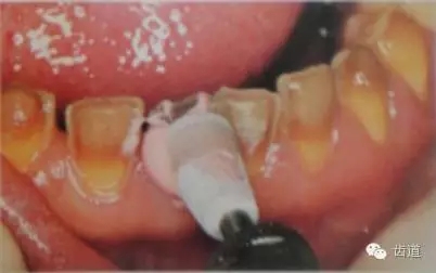 瓷貼面的粘接步驟及技術(shù)要點(diǎn) 瓷貼面的粘接步驟及技術(shù)要點(diǎn)