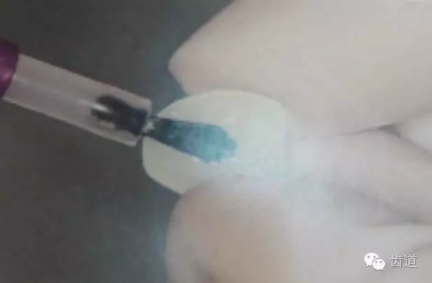 瓷貼面的粘接步驟及技術(shù)要點(diǎn) 瓷貼面的粘接步驟及技術(shù)要點(diǎn)