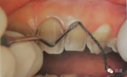 瓷貼面的粘接步驟及技術(shù)要點(diǎn) 瓷貼面的粘接步驟及技術(shù)要點(diǎn)