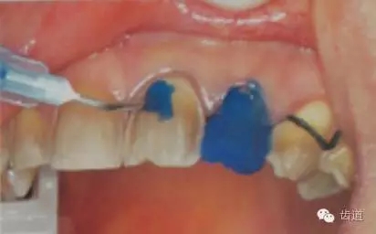 瓷貼面的粘接步驟及技術(shù)要點(diǎn) 瓷貼面的粘接步驟及技術(shù)要點(diǎn)