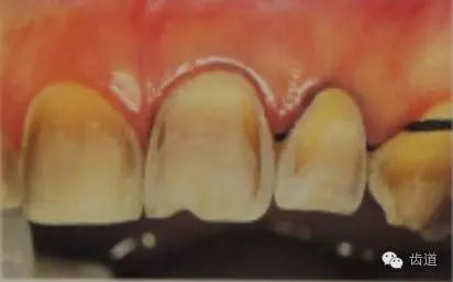 瓷貼面的粘接步驟及技術(shù)要點(diǎn) 瓷貼面的粘接步驟及技術(shù)要點(diǎn)