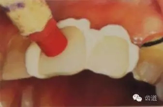 瓷貼面的粘接步驟及技術(shù)要點(diǎn) 瓷貼面的粘接步驟及技術(shù)要點(diǎn)