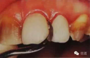 瓷貼面的粘接步驟及技術(shù)要點(diǎn) 瓷貼面的粘接步驟及技術(shù)要點(diǎn)