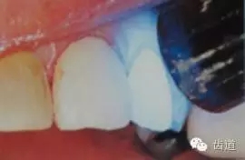 瓷貼面的粘接步驟及技術(shù)要點(diǎn) 瓷貼面的粘接步驟及技術(shù)要點(diǎn)