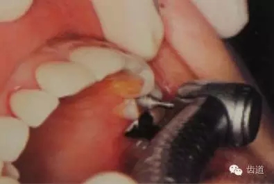 瓷貼面的粘接步驟及技術(shù)要點(diǎn) 瓷貼面的粘接步驟及技術(shù)要點(diǎn)