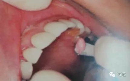 瓷貼面的粘接步驟及技術(shù)要點(diǎn) 瓷貼面的粘接步驟及技術(shù)要點(diǎn)