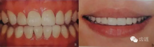 瓷貼面的粘接步驟及技術(shù)要點(diǎn) 瓷貼面的粘接步驟及技術(shù)要點(diǎn)