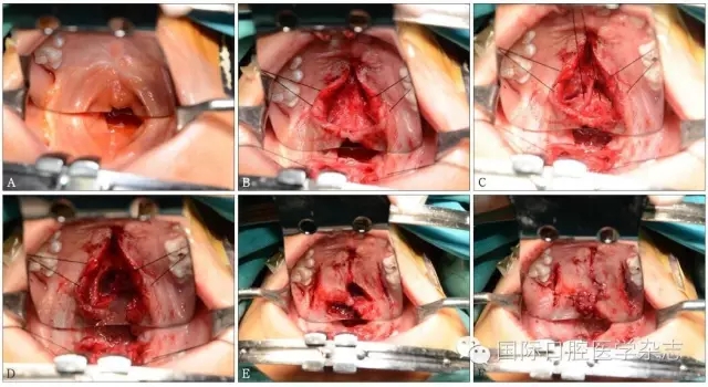 腭咽閉合不全的個(gè)體化治療策略 腭咽閉合不全的個(gè)體化治療策略