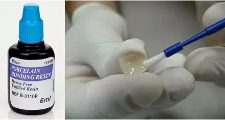 貼面粘接操作流程及要點(diǎn) 貼面粘接操作流程及要點(diǎn)