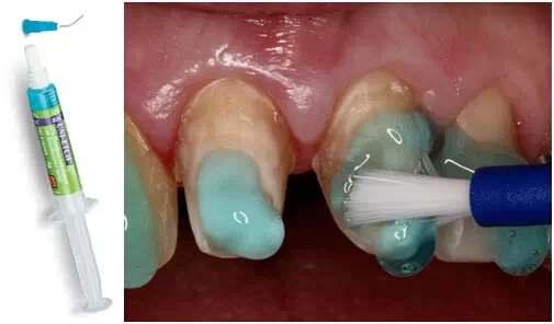 貼面粘接操作流程及要點(diǎn) 貼面粘接操作流程及要點(diǎn)