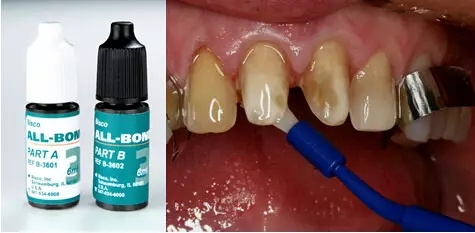 貼面粘接操作流程及要點(diǎn) 貼面粘接操作流程及要點(diǎn)