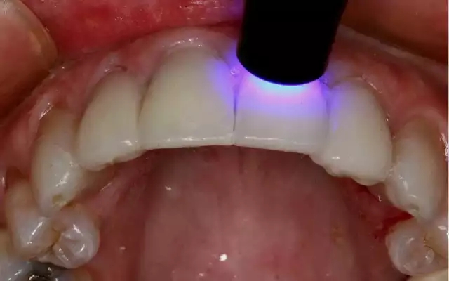 貼面粘接操作流程及要點(diǎn) 貼面粘接操作流程及要點(diǎn)