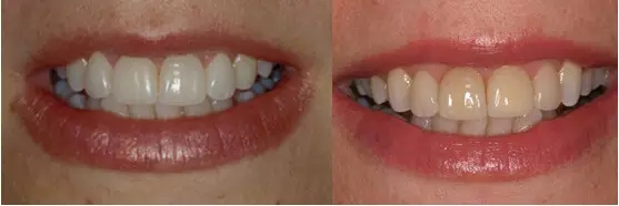 貼面粘接操作流程及要點(diǎn) 貼面粘接操作流程及要點(diǎn)