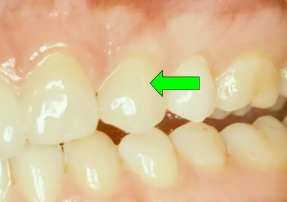 貼面粘接操作流程及要點(diǎn) 貼面粘接操作流程及要點(diǎn)