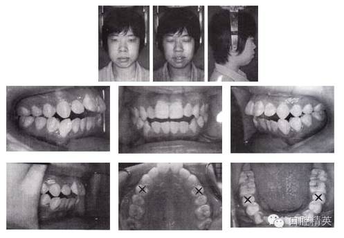 拔牙矯治開頜伴前突 拔牙矯治開頜伴前突