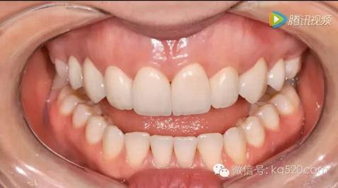 烤瓷牙邊緣變黑，要換新的嗎？