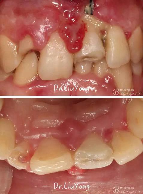 山西牙周劉勇:“前牙外傷患者的口腔多學(xué)科聯(lián)合治療”精彩案例分享 山西牙周劉勇:“前牙外傷患者的口腔多學(xué)科聯(lián)合治療”精彩案例分享