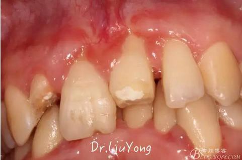 山西牙周劉勇：&ldquo;前牙外傷患者的口腔多學(xué)科聯(lián)合治療&rdquo;精彩案例分享