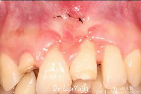 山西牙周劉勇:“前牙外傷患者的口腔多學(xué)科聯(lián)合治療”精彩案例分享 山西牙周劉勇:“前牙外傷患者的口腔多學(xué)科聯(lián)合治療”精彩案例分享