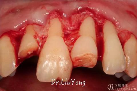 山西牙周劉勇:“前牙外傷患者的口腔多學(xué)科聯(lián)合治療”精彩案例分享 山西牙周劉勇:“前牙外傷患者的口腔多學(xué)科聯(lián)合治療”精彩案例分享