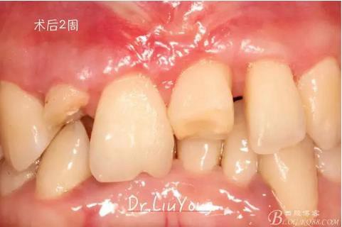 山西牙周劉勇:“前牙外傷患者的口腔多學(xué)科聯(lián)合治療”精彩案例分享 山西牙周劉勇:“前牙外傷患者的口腔多學(xué)科聯(lián)合治療”精彩案例分享