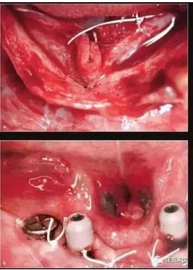牙醫(yī)引以為戒&mdash;&mdash;日本植牙手術(shù)死亡事件