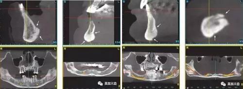 牙醫(yī)引以為戒&mdash;&mdash;日本植牙手術(shù)死亡事件