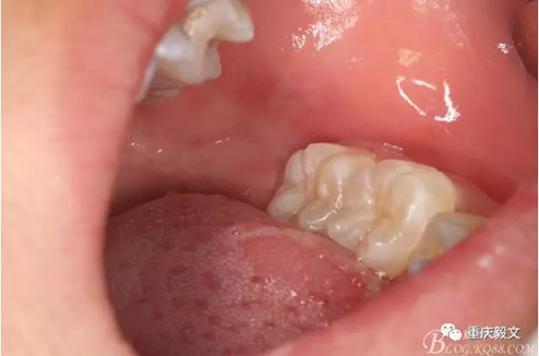 教材版的下頜埋伏智齒的拔除.png 教材版的下頜埋伏智齒的拔除.png