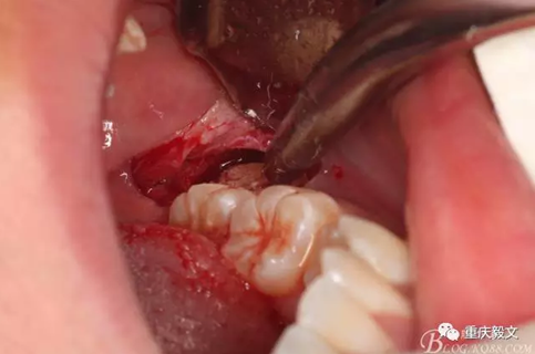 教材版的下頜埋伏智齒的拔除.png 教材版的下頜埋伏智齒的拔除.png