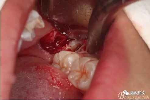 教材版的下頜埋伏智齒的拔除.png 教材版的下頜埋伏智齒的拔除.png