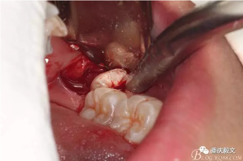 教材版的下頜埋伏智齒的拔除.png 教材版的下頜埋伏智齒的拔除.png