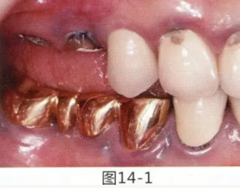 FGG法增大附著齦及根面覆蓋【牙齦-牙槽黏膜的問題】.png FGG法增大附著齦及根面覆蓋【牙齦-牙槽黏膜的問題】.png