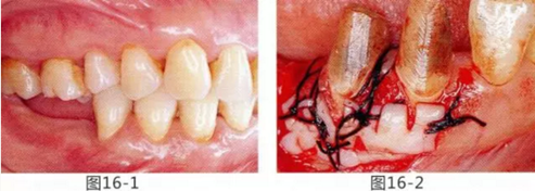 FGG法增大附著齦及根面覆蓋【牙齦-牙槽黏膜的問題】.png FGG法增大附著齦及根面覆蓋【牙齦-牙槽黏膜的問題】.png