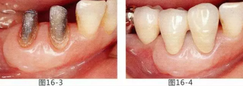 FGG法增大附著齦及根面覆蓋【牙齦-牙槽黏膜的問題】.png FGG法增大附著齦及根面覆蓋【牙齦-牙槽黏膜的問題】.png