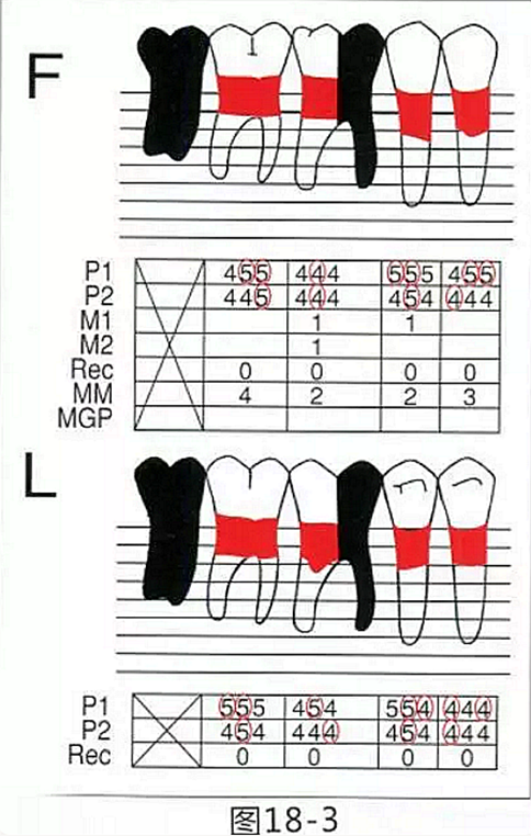 FGG法增大附著齦及根面覆蓋【牙齦-牙槽黏膜的問題】.png FGG法增大附著齦及根面覆蓋【牙齦-牙槽黏膜的問題】.png